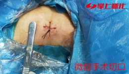 頸椎病開刀？這個傷口只有8毫米