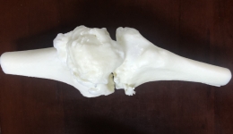 3D打印技術(shù)重塑患者“膝”望七旬老人感慨太神奇 ——我院成功完成一例3D打印復(fù)雜膝關(guān)節(jié)置換手術(shù)