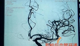 【大醫(yī)精誠(chéng)在湖一】八旬老人突發(fā)急性缺血性腦卒中，醫(yī)院上演“生命接力”