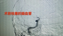 【卓越醫(yī)療在湖一】 90歲老人突發(fā)腦梗死，介入取栓技術(shù)創(chuàng)造生命奇跡