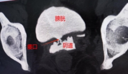 【卓越醫(yī)療在湖一】 復(fù)雜性膀胱陰道瘺：困擾桂女士半年的“漏尿”痛楚沒啦！